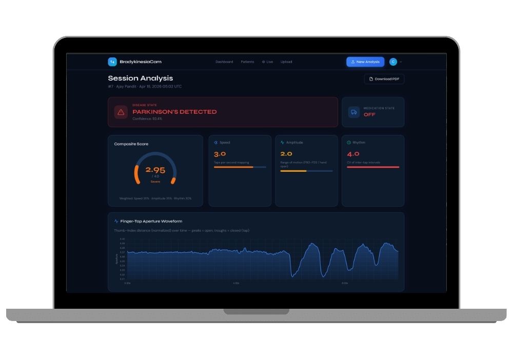 BradykinesiaCam — AI-Powered Parkinson's Disease Finger Tap Assessment System